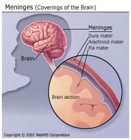 Meningitis