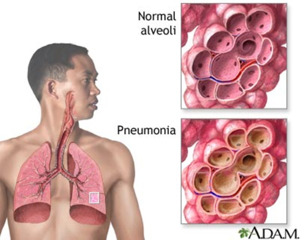 pneumonia.