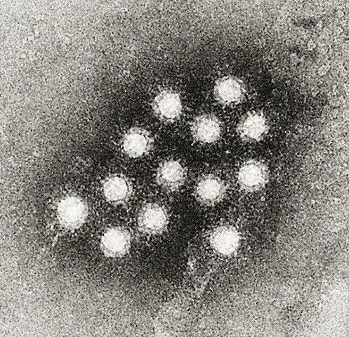 hepatitis A.