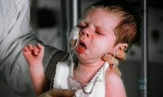 Whooping cough