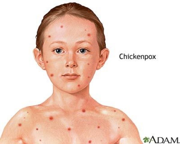 Chicken Pox