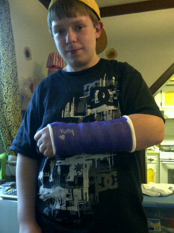 Mi hijo se rompió el brazo