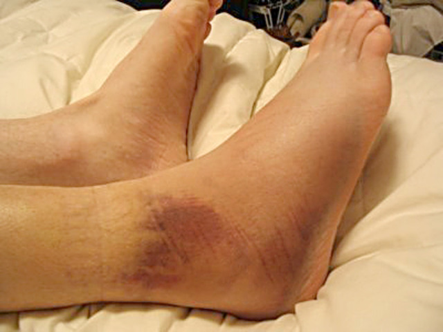 Broken Ankle
