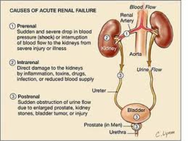 renal rejection