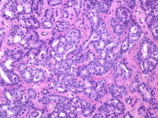 Prostate Cancer Diagnosis confirmed