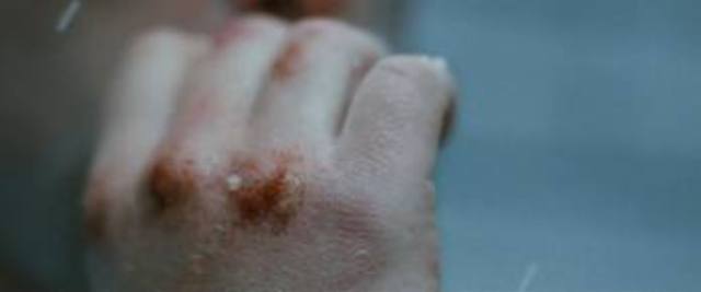 Tennyson's scabs are gone