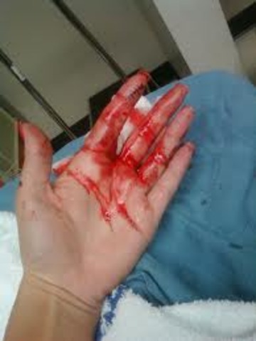 Bronte cuts her hand