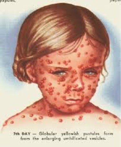 Last Case of Smallpox Occured
