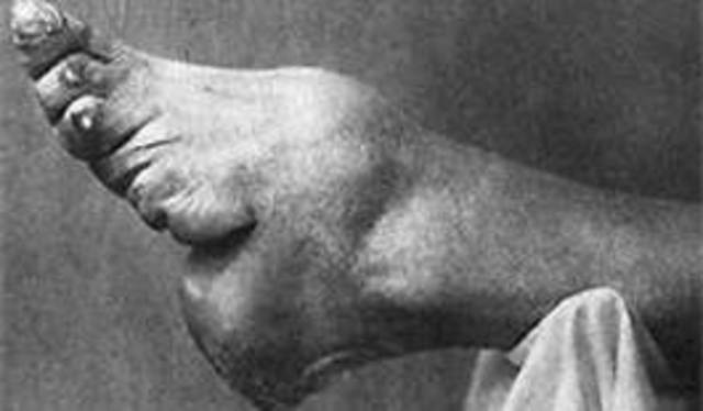 Foot Binding (Social)