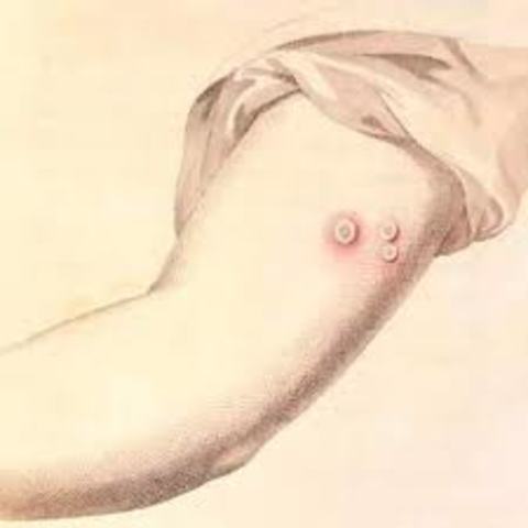 Smallpox in the Americas