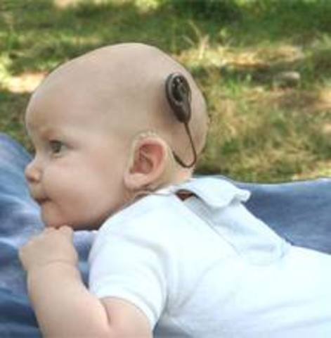 Cochlear Implants in Children