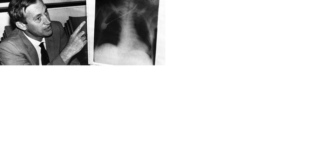 First human to human heart transplant