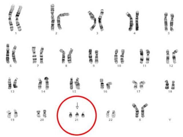 Chromosome 21