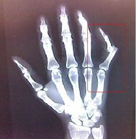 Broken pinky