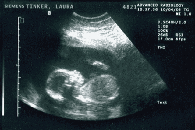 First Sonogram
