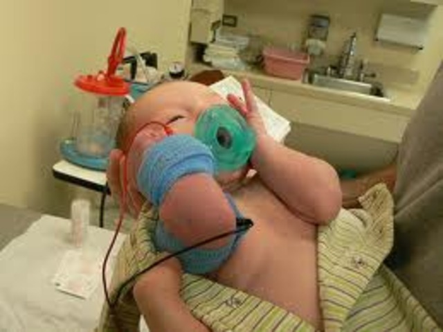 Sweat Test Developed