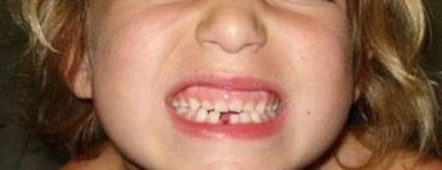 ¡¡ SE ME CAE MI PRIMER DIENTE !!