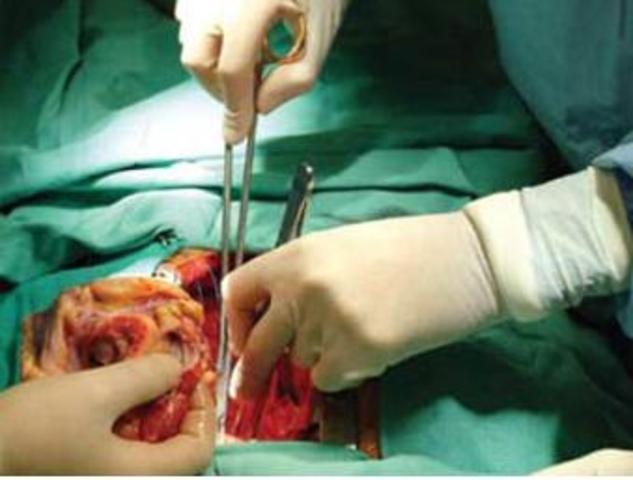 Перша пересадка серця