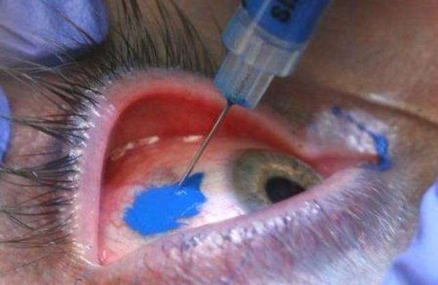 se tatúa completamente el ojo.