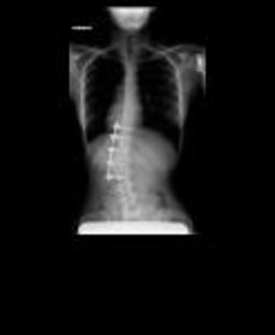 Had Anterior Spinal Fusion Surgery to correct my scoliosis.  Here is my X-ray after surgery. I was fused T-10 to L-2. I was left with a curve below my fusion.