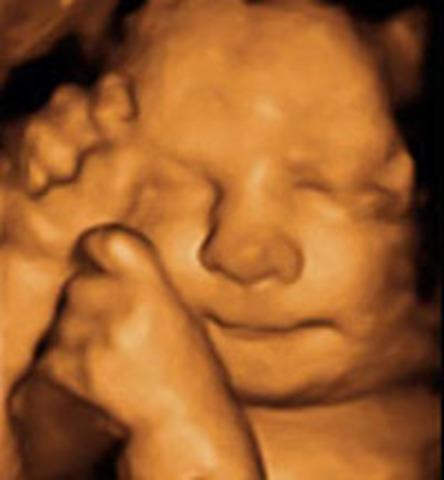 DESARROLLO FETAL: SEMANA 13 A 16