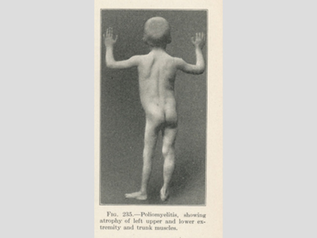 First U.S. Polio Epidemic