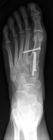 I had bunion surgery on my left foot.