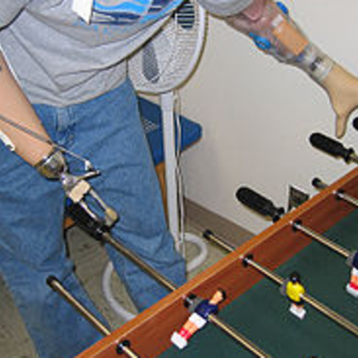 Timeline: History of Upper Body Prosthesis