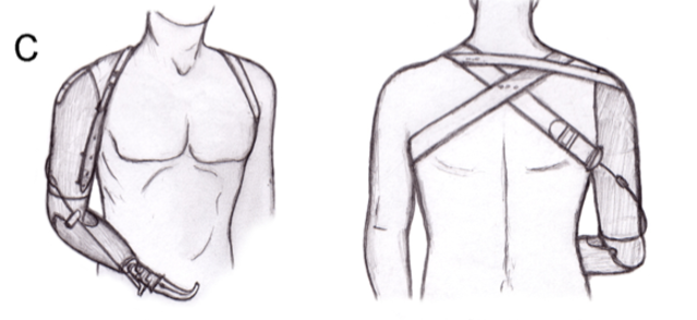 Prostheic arm developed that could be controlled by the opposite shoulder with connecting straps.