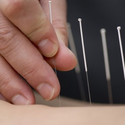 Timeline: Acupuncture: A Walk Through Its History