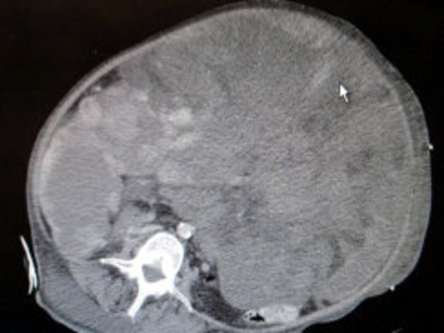 51 Pound Tumer Removed From New Jersey Woman's Stomach