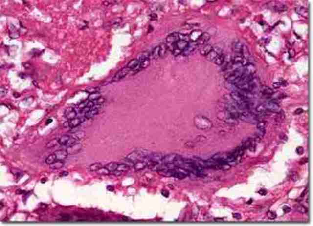 Bacil de la tuberculosi