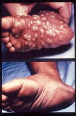 Vacuna contra la verola