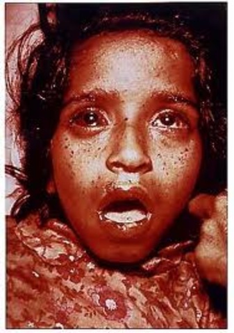 smallpox