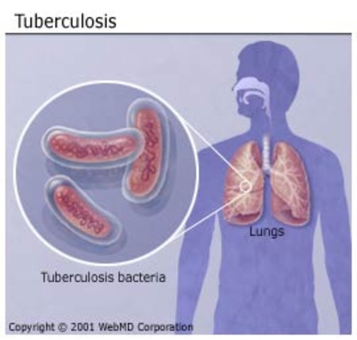 John is diagnosed with Tuberculosis.