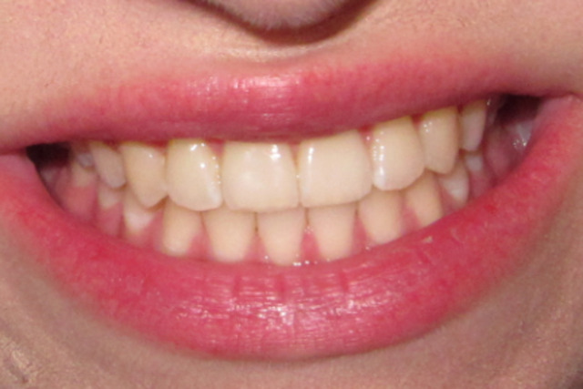 Le dentiste m´a quitè l´ appareil