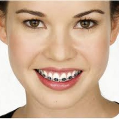 Timeline: Braces
