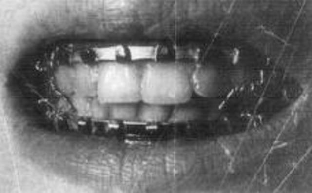 Braces date back to 400-300 BC