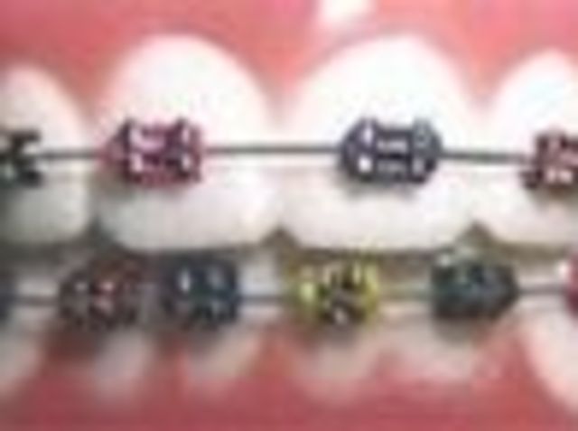 Braces are used to help align and straighten teeth