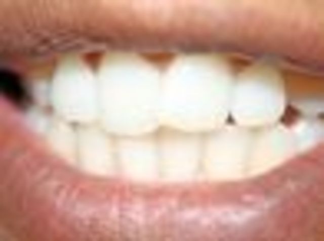 Orthodontics, as it is now known, was established in 1819 by Frank Delabarre, who invented the wire crib.