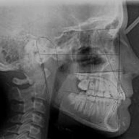 During the 1800's steady advances were made such as gum elastics and orthodontic x-rays