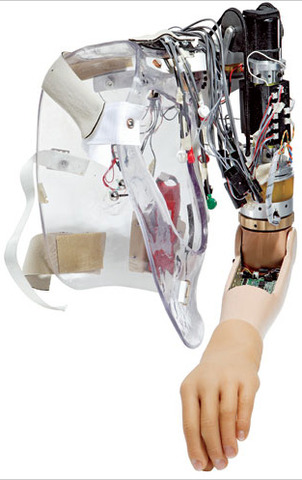 Active Bionic Prosthesis ( Robotic Limbs)