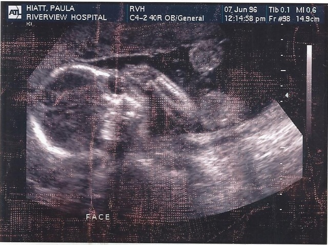 Hace diez y seis años que estuve en estómago de mi madre