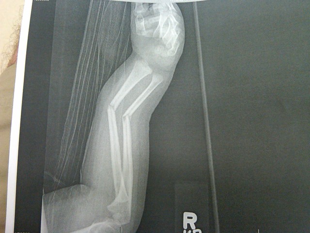 BROKEN ARM AT 2 YEARS OLD