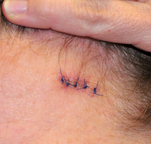 Got stiches in my head