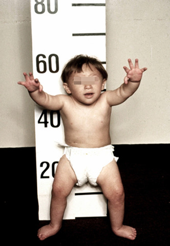 Primer transplantament amb cèl.lules de sang del cordó umbilical