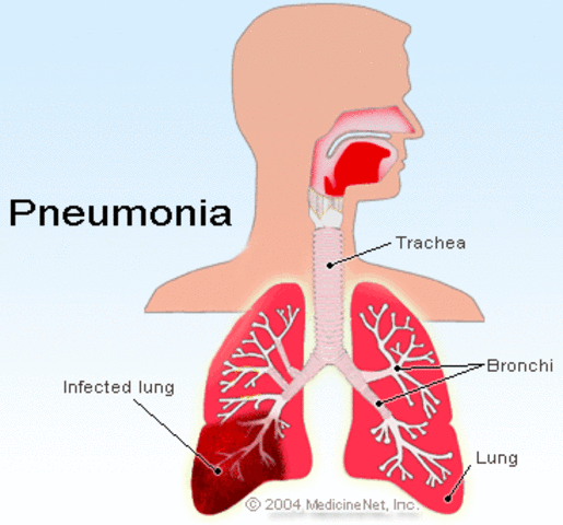 Vaccine for Pneumonia