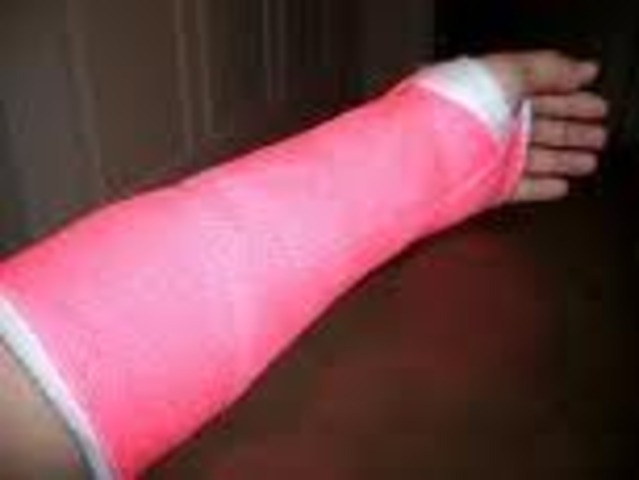 I broke my arm