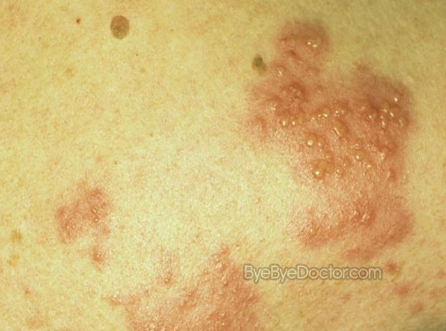Shingles Vaccination