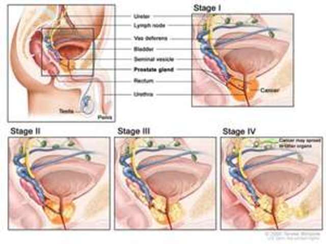 Diagnosed with Prostate Cancer